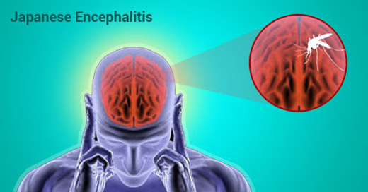 	encephalitis 1...